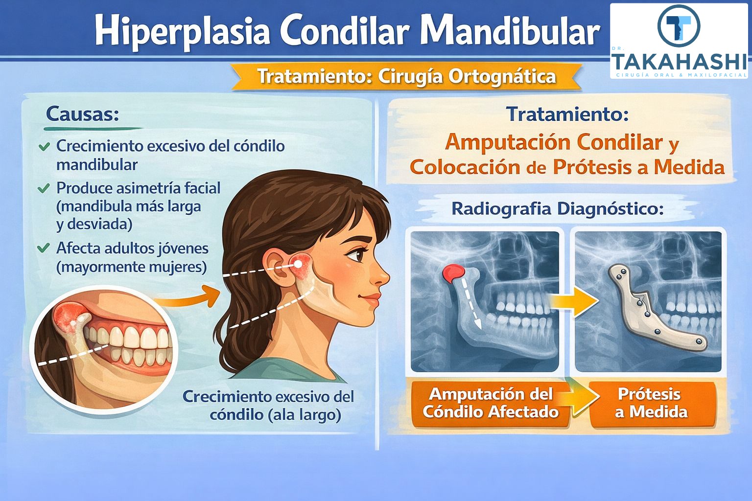 Hiperplasia condilar mandibular - Dr. Carlos Takahashi Hiperplasia condilar mandibular - Dr. Carlos Takahashi